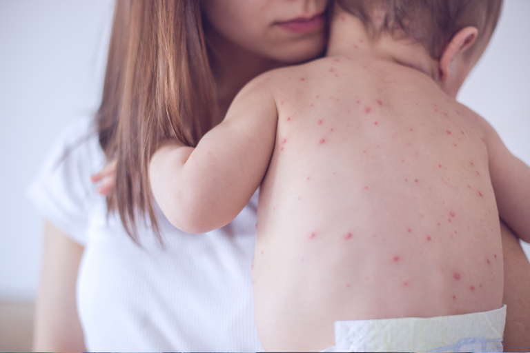 Measles Vaccines